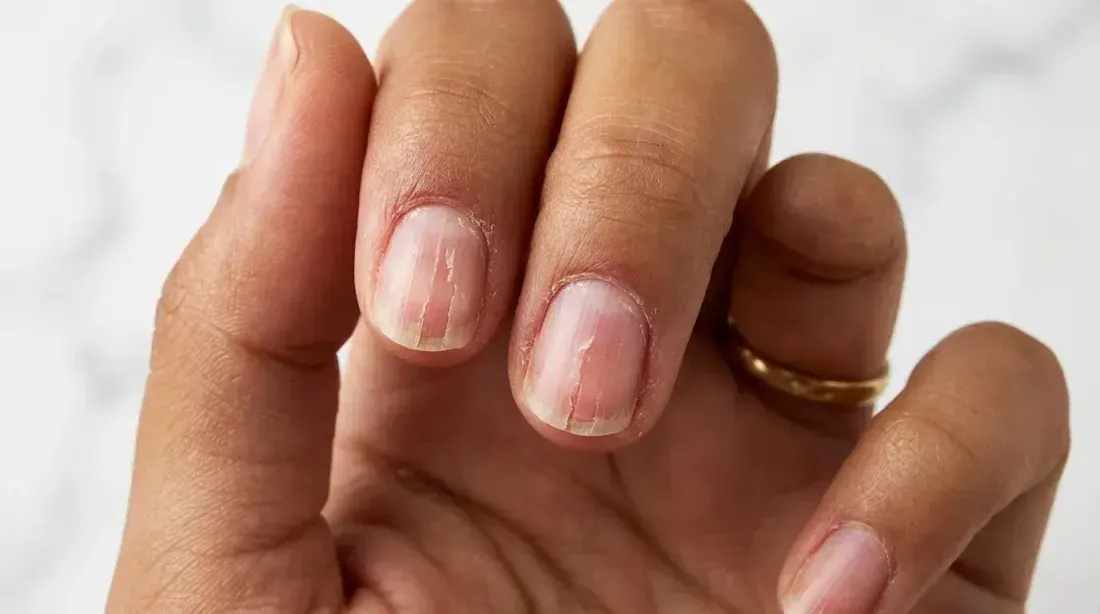Pro Tips for Peeling Nail Recovery