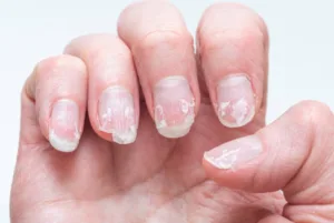 Peeling Nails